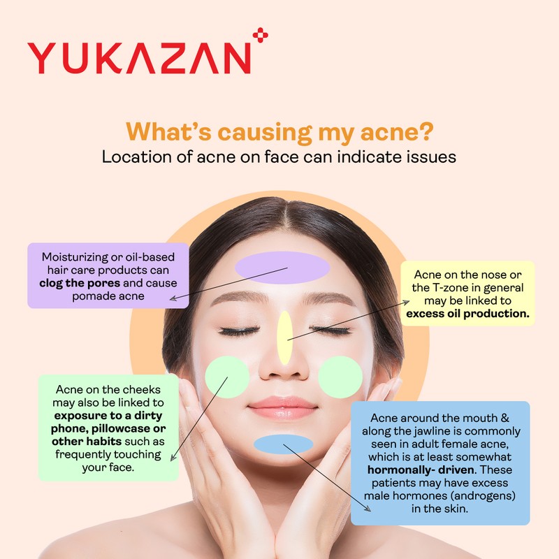 Yukazan Derma Refining Cream Acne & Pore 30ml Acne Removal