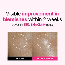 ISOI ISOI Blemish Care Up Serum, Vegan Hydrating Serum for Smooth & Glass Skin Effect, Skin Barrier & Moisture Balance, Korean Skin Care (1.18 fl. oz, 35ml)