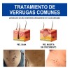Líquida De Eliminación De Verrugas Y Mezquinos 30ml