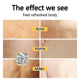 Acne body wash ubat jerawat badan Whitening sabun hilangkan badan Whitening Shower Gel men women Remove chicken skin mites back acne moisturizing body wash for sensitive skin (260ml)痘痘沐浴露