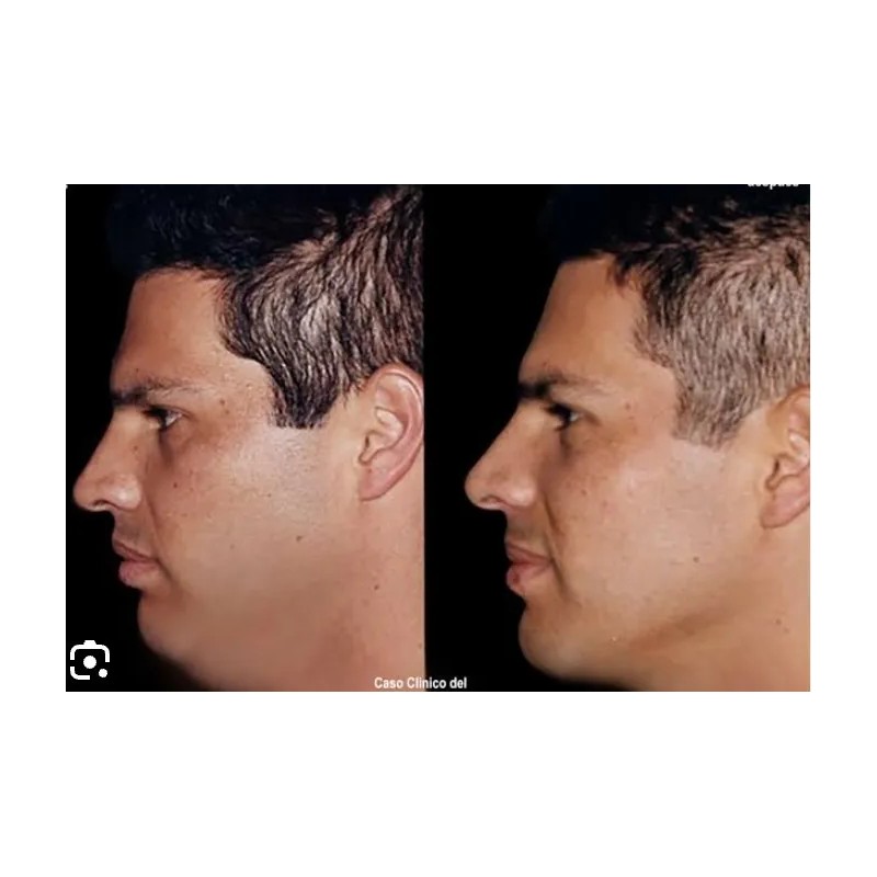 Tratamiento Reductor De Papada Cuello Caido Negro Arrgugas Mixta Delicada