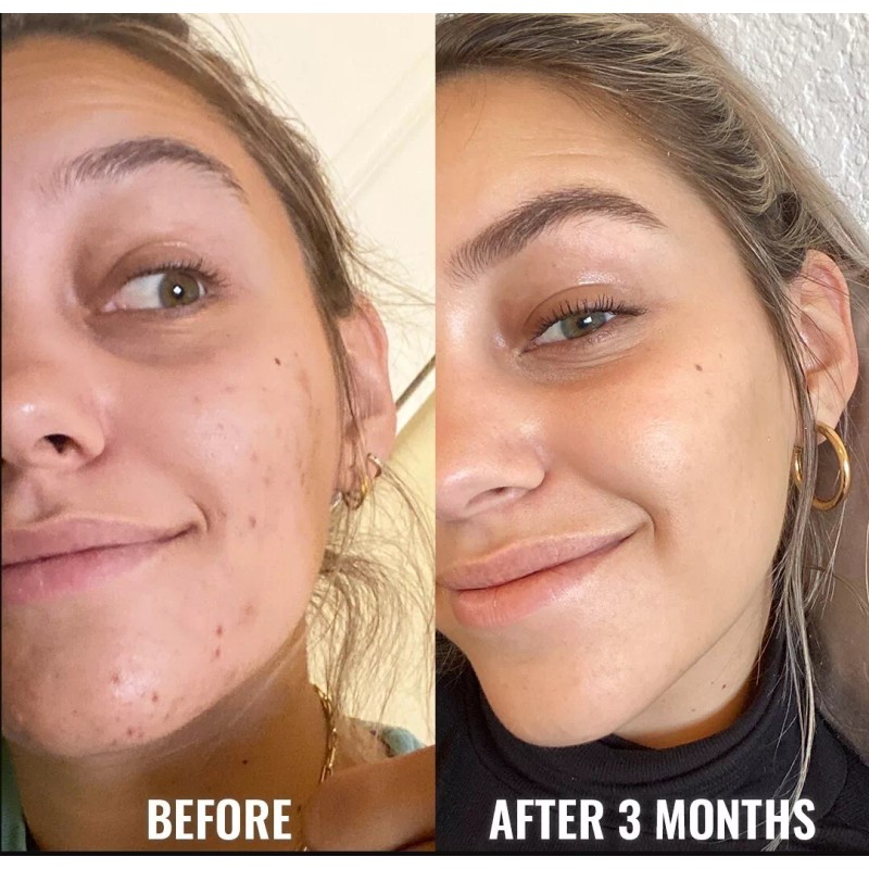 Niacinamide 10% +Zink 1% +Hyaluronic Acid | Acne/Blemish/Oil Control Serum/Cream