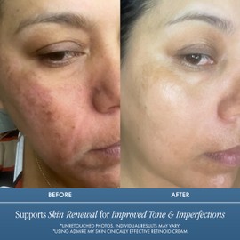 Admire My Skin Potent Retinoid Cream - Anti Aging Retinol Cream Moisturizer to Help Clear Acne Prone Skin, Eliminate Wrinkles and Provide You With That Healthy Youthful Glow