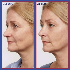 L'OREAL PARIS L'Oreal Paris Pure Retinol Serum, Revitalift Laser Deep Anti-Wrinkle Retinol Night Serum For Face [Revitalift Laser Retinol Serum 30ml + x3 Hydra Genius Moisturiser Sachets 3ml]