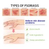 Pomada Psoriasis Natural Antipicazón Hongos Efectiva 20g