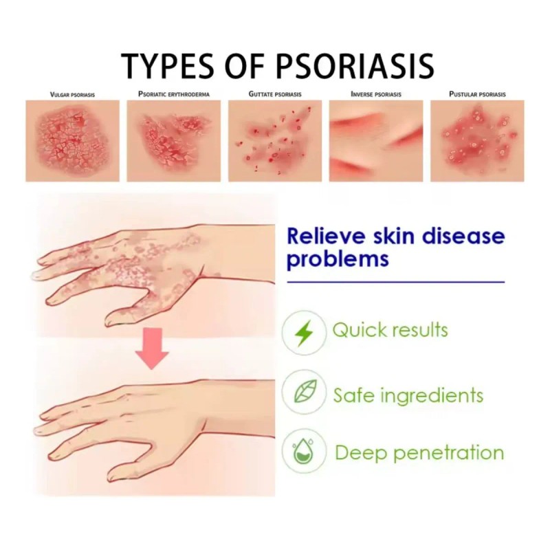 Pomada Psoriasis Natural Antipicazón Hongos Efectiva 20g