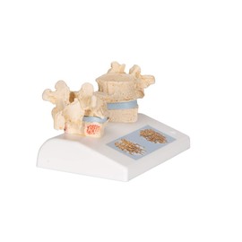 3B Scientific Human Anatomy - Osteoporosis Model + Free Anatomy App - 3B Smart Anatomy