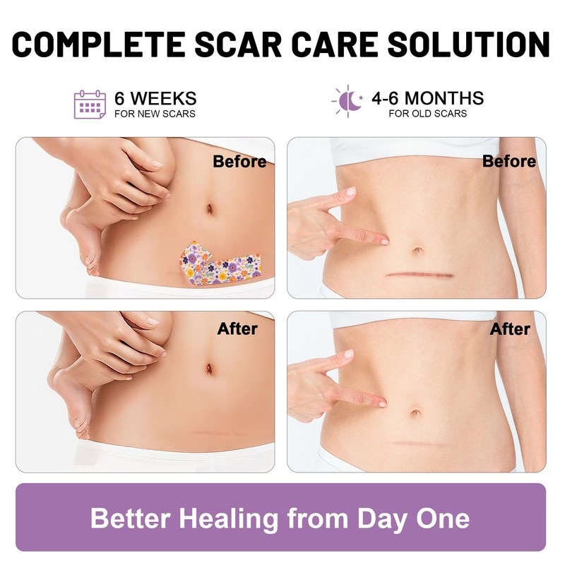 SLGCBL Silicone Scar Sheets, Reusable Silicone Scar Tape Roll for