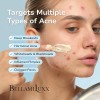 Tratamiento Bellamiluxx Para El Acné Quístico Facial: Crema