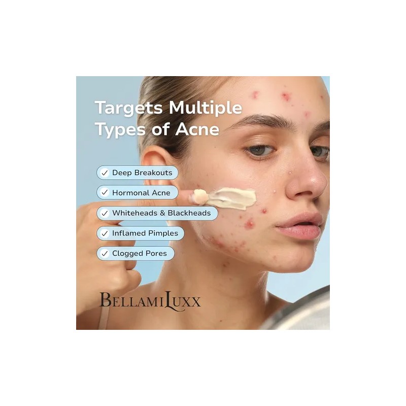 Tratamiento Bellamiluxx Para El Acné Quístico Facial: Crema