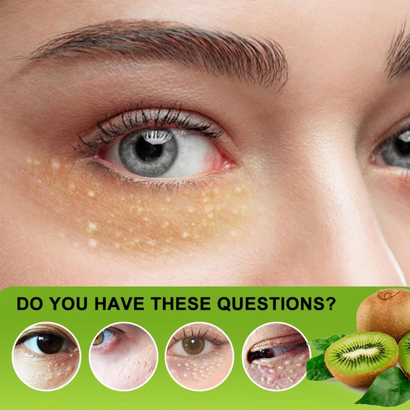 Vitamin E Milia Cream - Milia Daily Eye Care for