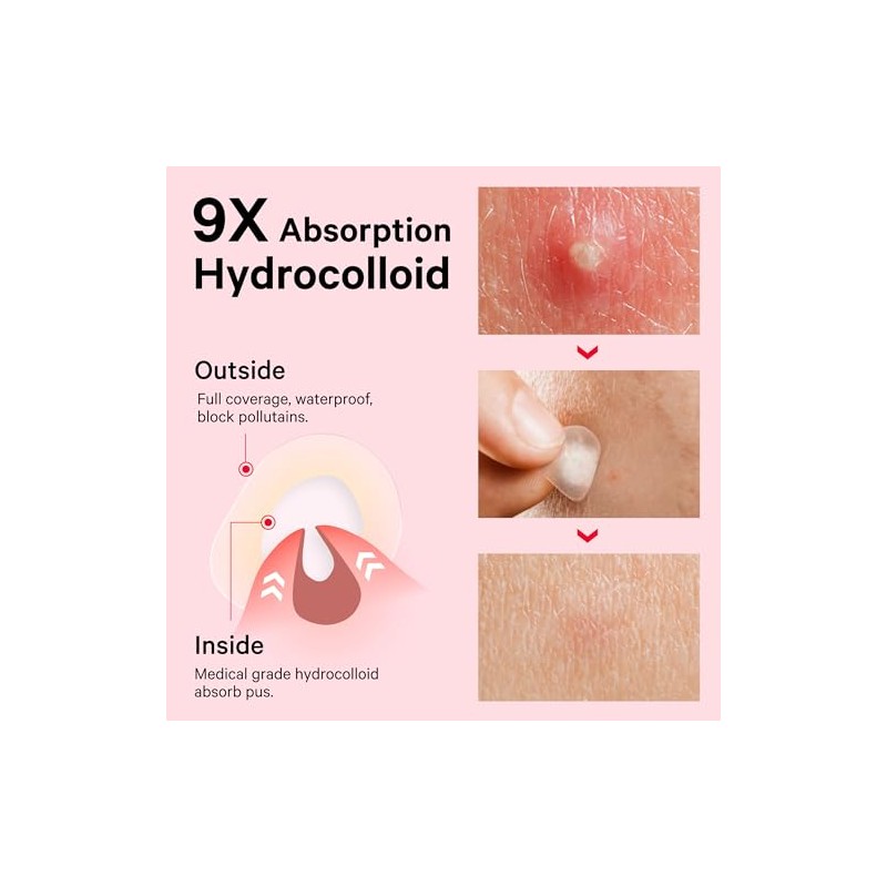 Sosky Invisible Hydrocolloid Acne Patches with Salicylic Acid - 48