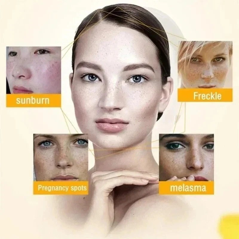 Effective Whitening Freckle Cream Remove Dark Spot Cream Removal Melanin