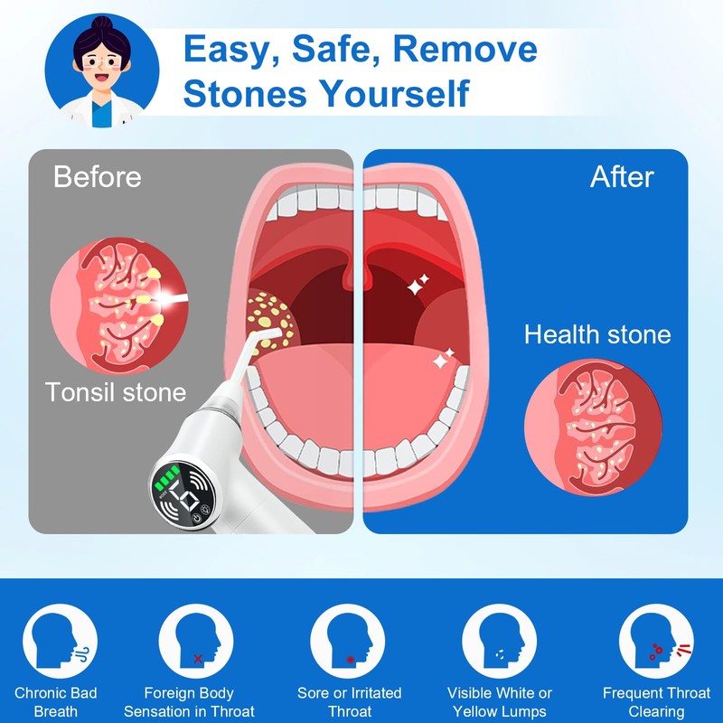 Tonsil Stone Remover Tool, Upgraded Electric Tonsil Stone Removal Kit