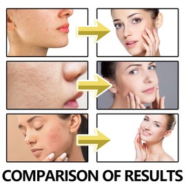 5% Hyaluronic Acid Serum,Hyaluronic Acid Serum for Face,Hyaluronic Aci-d Tubes Smoother Skin,Anti-Aging Face Se-rum,Fa-ce Ser-um for Women,Moisturiser Fa-ce,Skin Tightening for Fa-ce,Skincare