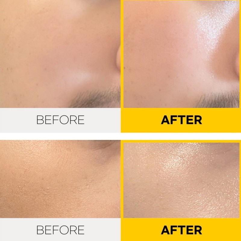 Skincheom Mini Iron Stick Between Eyes Under Eyes Neck Wrinkle