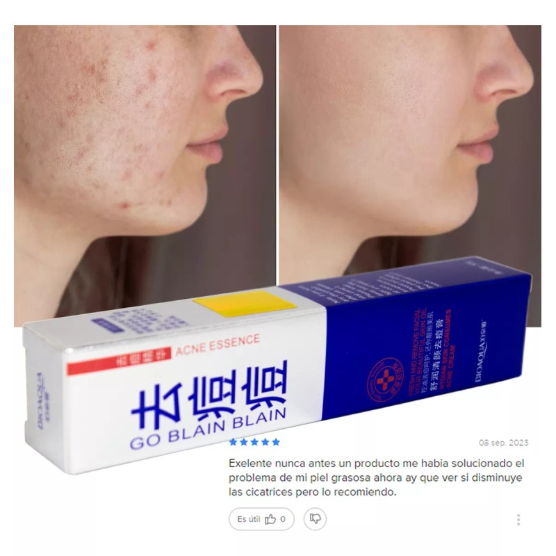 ANTI- ACNÉ Anti Acne Crema Cicatrices Cacarizos Grasa Tratamiento Piel