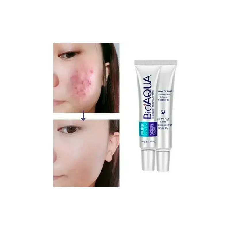 Tratamiento Acne Puntos Negros Manchas Cicatrices Barros