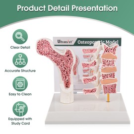 Ultrassist Osteoporosis Human Anatomy Model - Vertebrae Skeleton Sectional Model with Study Card for Medical Teaching Demonstration, Medical Students & Healthcare Educators