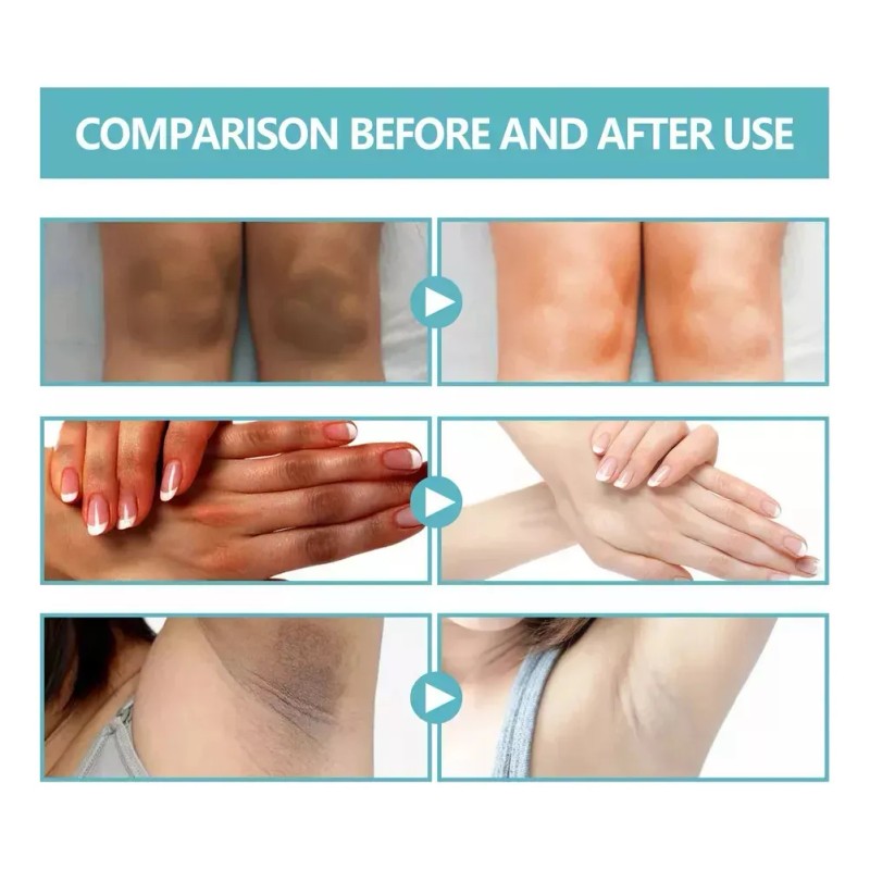 Fixderma Nigrifix Crema Para Acantosis Nigricans Fbg