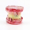 Global-Dental Removable Implant Studying Analysis Demonstration Teeth Model with Restoration