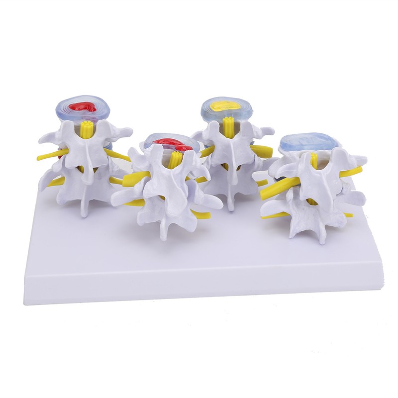 4-stage Medicals Human Lumbar Vertebrae Combination of Normal and Pathological