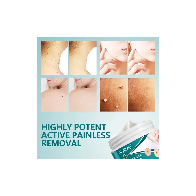 Crema Removedora Mezquinos Verrugas Lunares Eficaz Sin Dolor