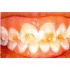 2 Thermo-molding Custom Fitting Whitening Trays