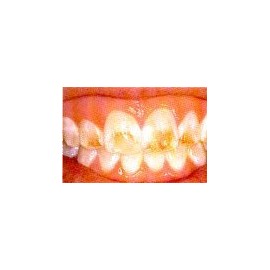 2 Thermo-molding Custom Fitting Whitening Trays