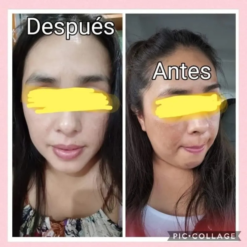 Crema Aclaradora Quita Manchas Paño Y Sol Melasma