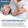 TreeActiv Psoriasis Treatment Cream, 8oz, Psoriasis Cream with Hyaluronic Acid