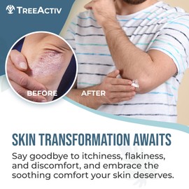 TreeActiv Psoriasis Treatment Cream, 8oz, Psoriasis Cream with Hyaluronic Acid for Face, Scalp, Body, Soothing Cream for Psoriasis Treatment, Psoriasis Moisturizing Cream for Scaly Dry Skin, 500+ Uses
