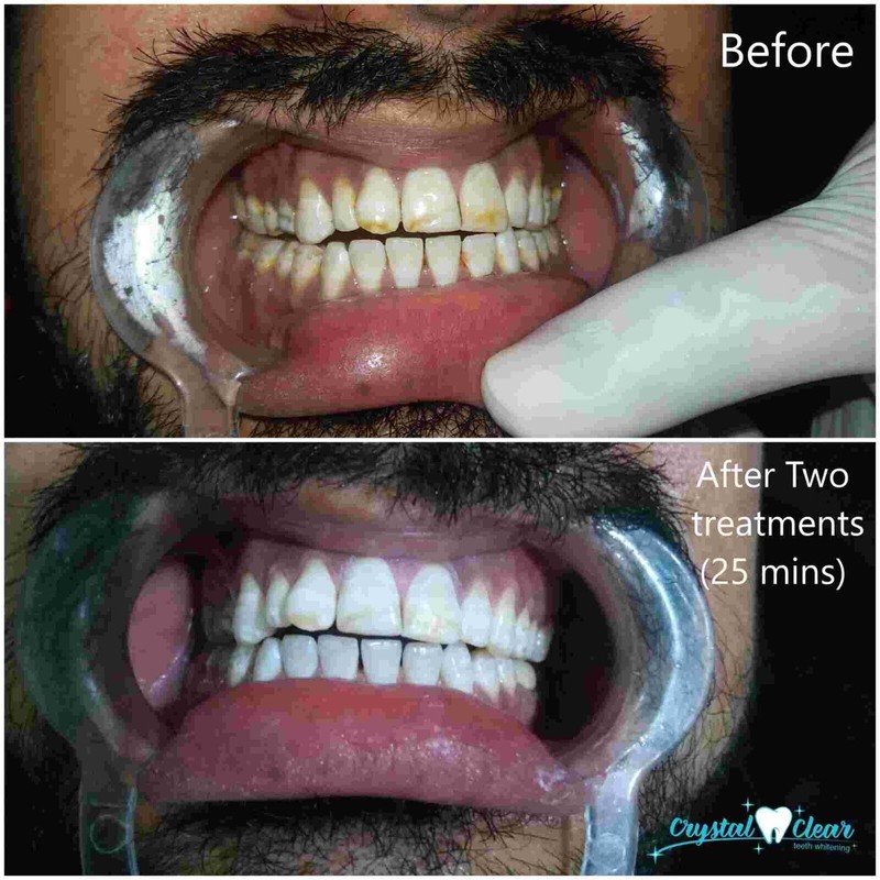 Crystal Clear Teeth Whitening Kit de Gel Blanqueador de Dientes