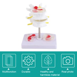 Anatomical Lumbar Disc Herniation Model Human Spine Training Supplies d3e2