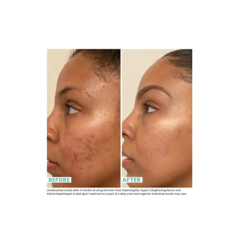 Urban Skin Rx 3-in-1 Even Tone Cleansing Bar - 2.0oz