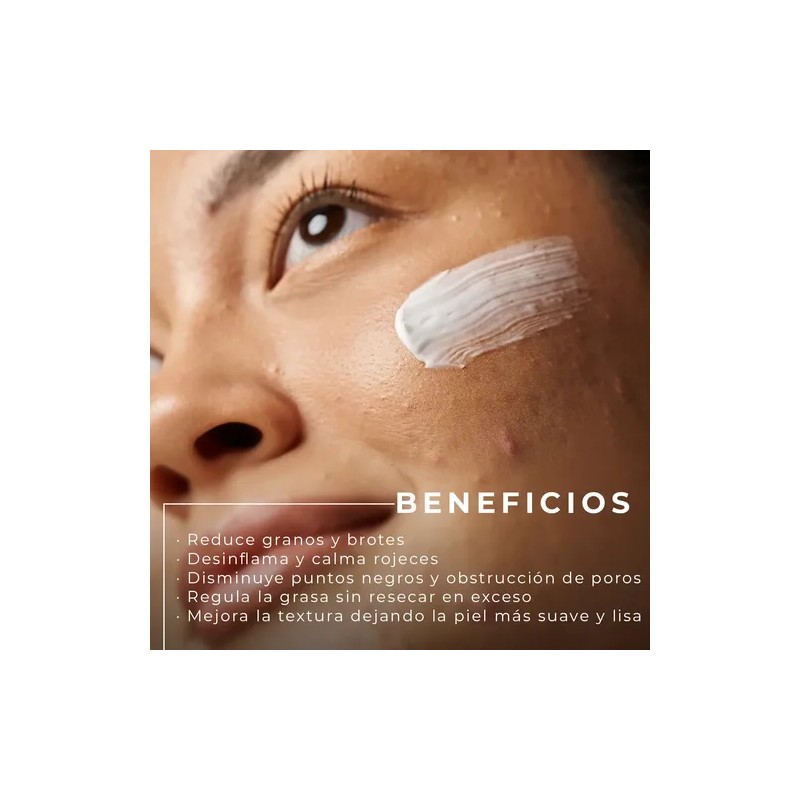 Crema Anti Acné Mc Life Control De Grasa Reduce Manchas