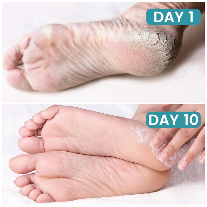 Cracked Foot Cream Roll-On Moisturizer, 1.76floz