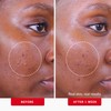 First Aid Beauty Acne Pads for Face - Maximum Strength