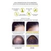 Sérum Para El Crecimiento Del Cabello, Aceite De Jengibre Ve