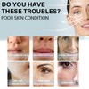 Face Lifting, Collagen Silk Threads, Collagen Silk Threads for Lifting,