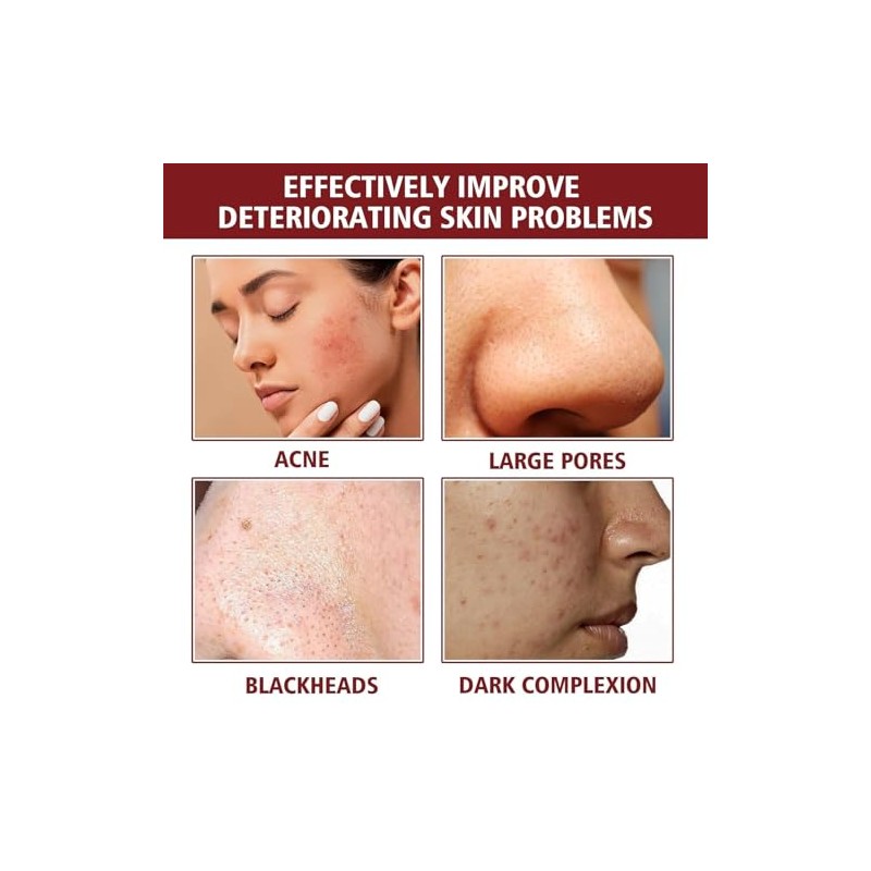 Solución Peeling Facial AHA BHA - Sérum Exfoliante Facial con