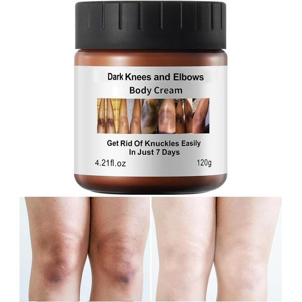Dark Knees and Elbow Remover Cream, Intimate Area Dark Spot