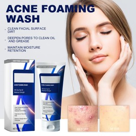 Akne Clean Foam Cleanser, 156 G Acne Foaming Wash Akne Schaumwäsche Sanfter Reinigungsschaum Gesichtsreinigungsschaum, Tiefenporen-Reinigungsschaum Zur Gesichtsreinigung Gegen Make-Up, Schmutz (10%)