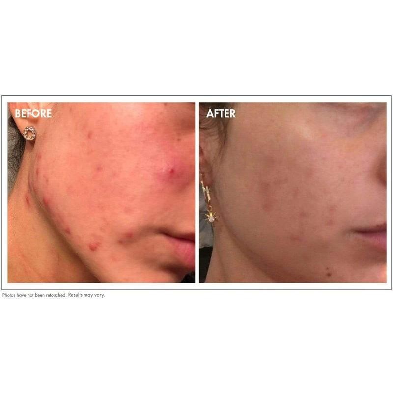 Probiotic Acne Treatment Cleanser 5 oz