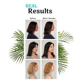 Hair La Vie Clinical Formula Hair Vitamins with Biotin and Saw Palmetto - Healthy Hair and Whole-Body Wellness (2-Pack)