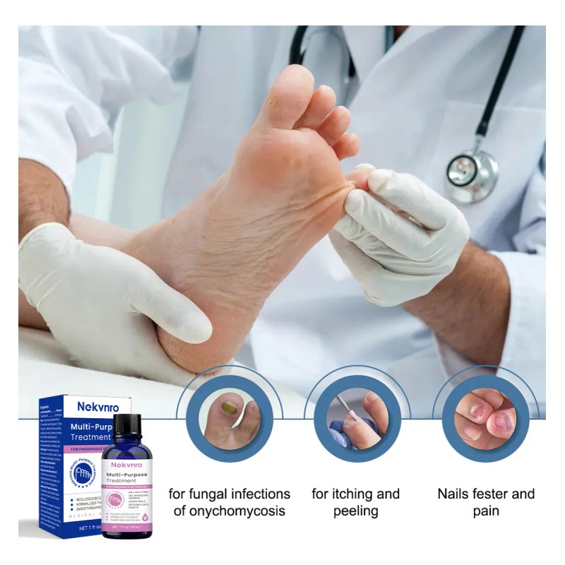 30ml Líquido Antibacteriano De Uñas Grises P/ Uñas Enfermas