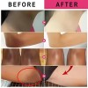 Adecuado Para Manchas, Cloasma Y Acné. Crema Antipecas.
