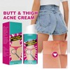 Ass Acne Cream, Pimple Cream, Pimple Reduction, Pimple Reduction, Restore