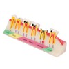 Caries Model Dental Caries Model, Model Teeth Teaching Dental Gum
