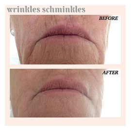 Wrinkles Schminkles Mouth and Lip Wrinkle Patch - 1 Patch